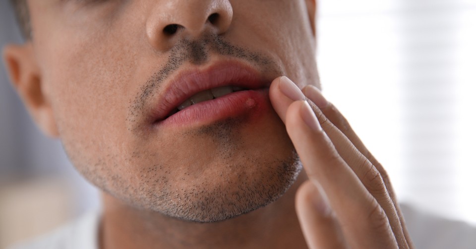 Man with an oral herpes sore